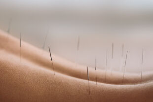 Akupunktur Nadeln - © Foto: iStock/miljko