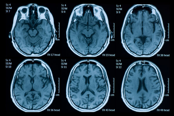 Gehirnscans, Hirnforschung - Das Bild zeigt sechs Gehirnscans in blauer Farbe auf schwarzem Hintergrund - © Foto: iStock/temet